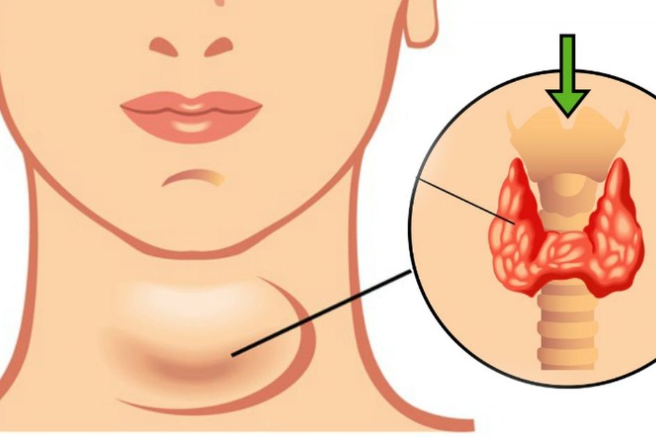 Hipotiroidisme: Tiroid Penyebab Kenaikan Berat Badan