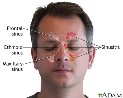 Sinusitis: Penyebab Hidung Tersumbat yang Sering Diabaikan