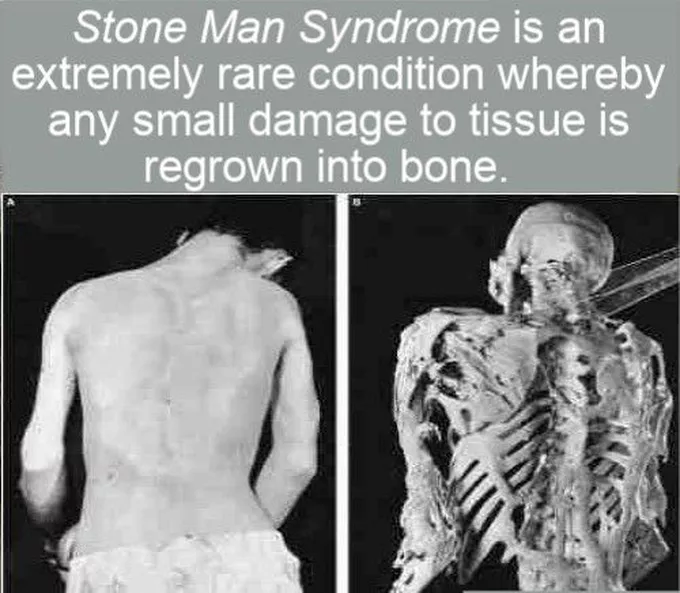 Stone Man Syndrome: Ketika Otot Berubah Menjadi Tulang