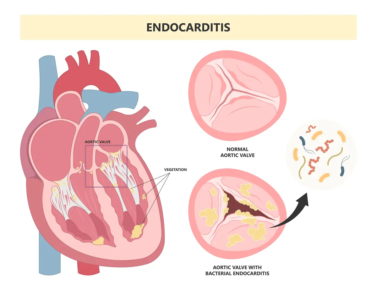 Endokarditis: Infeksi Jantung Sering Tak Disadari