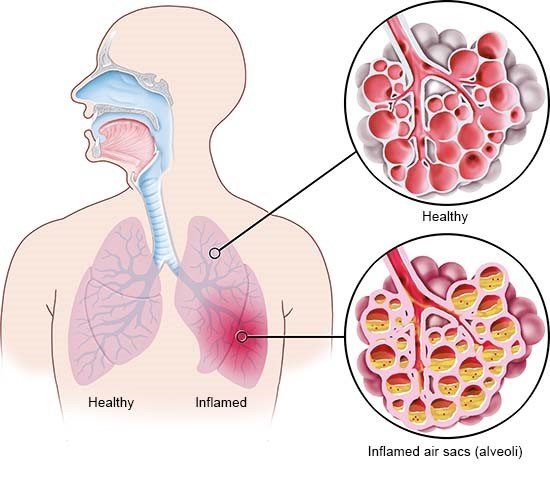 Pneumonia: Infeksi Paru yang Bisa Berakibat Fatal