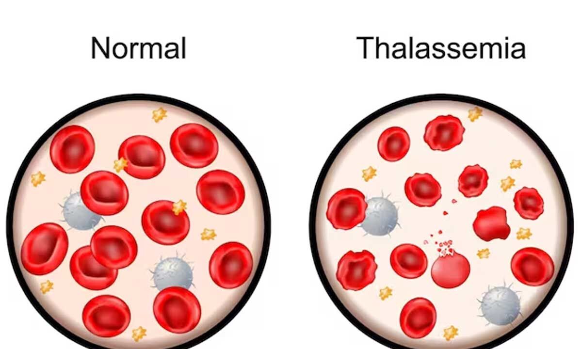 thalassemia